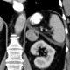 Adrenal myelolipoma: CT - Computed tomography